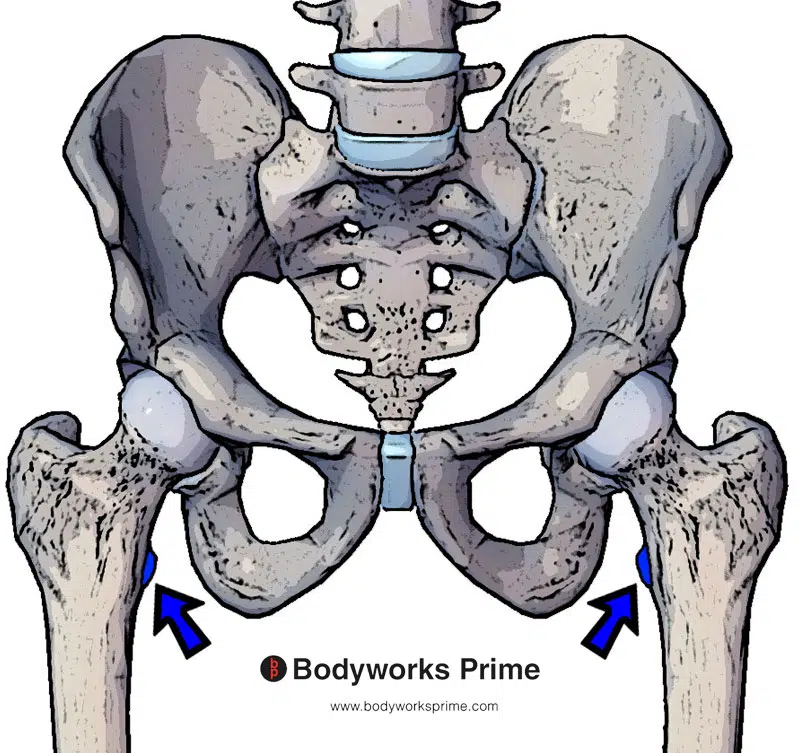 iliacus insertion marked in blue on the lesser trochanter of the femur